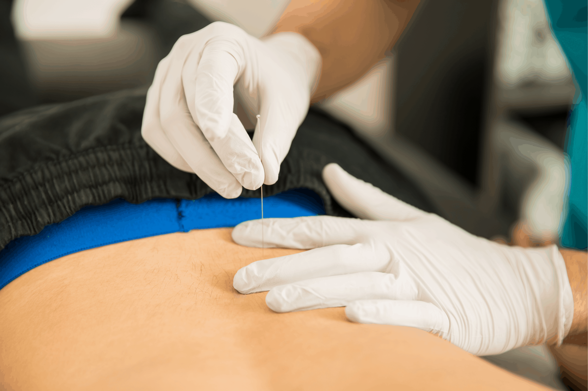 Intramuscular Stimulation